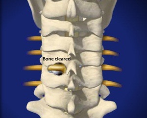 Cervical Foraminotomy Step 2 Removal of Spinal Bone