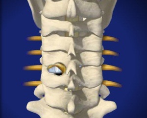 Cervical Foraminotomy Birmingham AL Spine And Neurosurgery