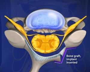 Cervical Laminoplasty Step 5 Placing Bone Wedges