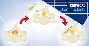 Cervical Laminoplasty