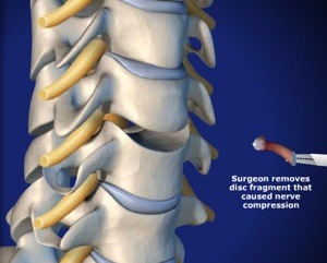 Cervical Artificial Disc (Arthroplasty) Step 2 Disc Removal