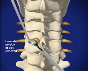 Cervical Foraminotomy Step 3 Removal of Herniated Disc