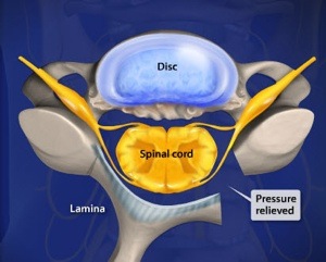Cervical Laminoplasty Step 4 Opening Back of Vertebrae