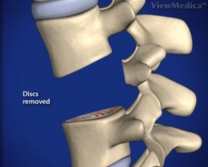 Lumbar Corpectomy and Fusion Step 2 Removal of Discs