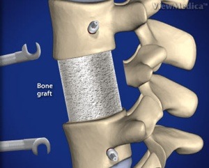 Lumbar Corpectomy and Fusion Step 4 Insertion of Bone Graft