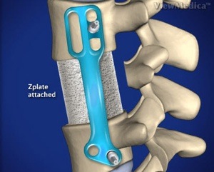 Lumbar Corpectomy and Fusion Step 5 Insertion of Zplate