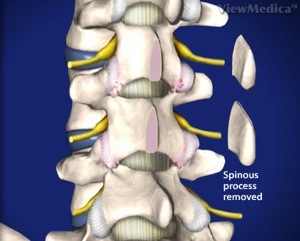 Lumbar Laminectomy Step 2 Removal of Spinous Process
