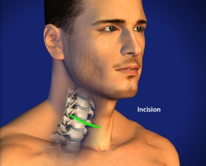 Anterior Cervical Discectomy Step 1 Incision