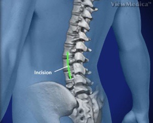 Transforaminal Lumbar Interbody Fusion Step 1 Incision and Spinal Access